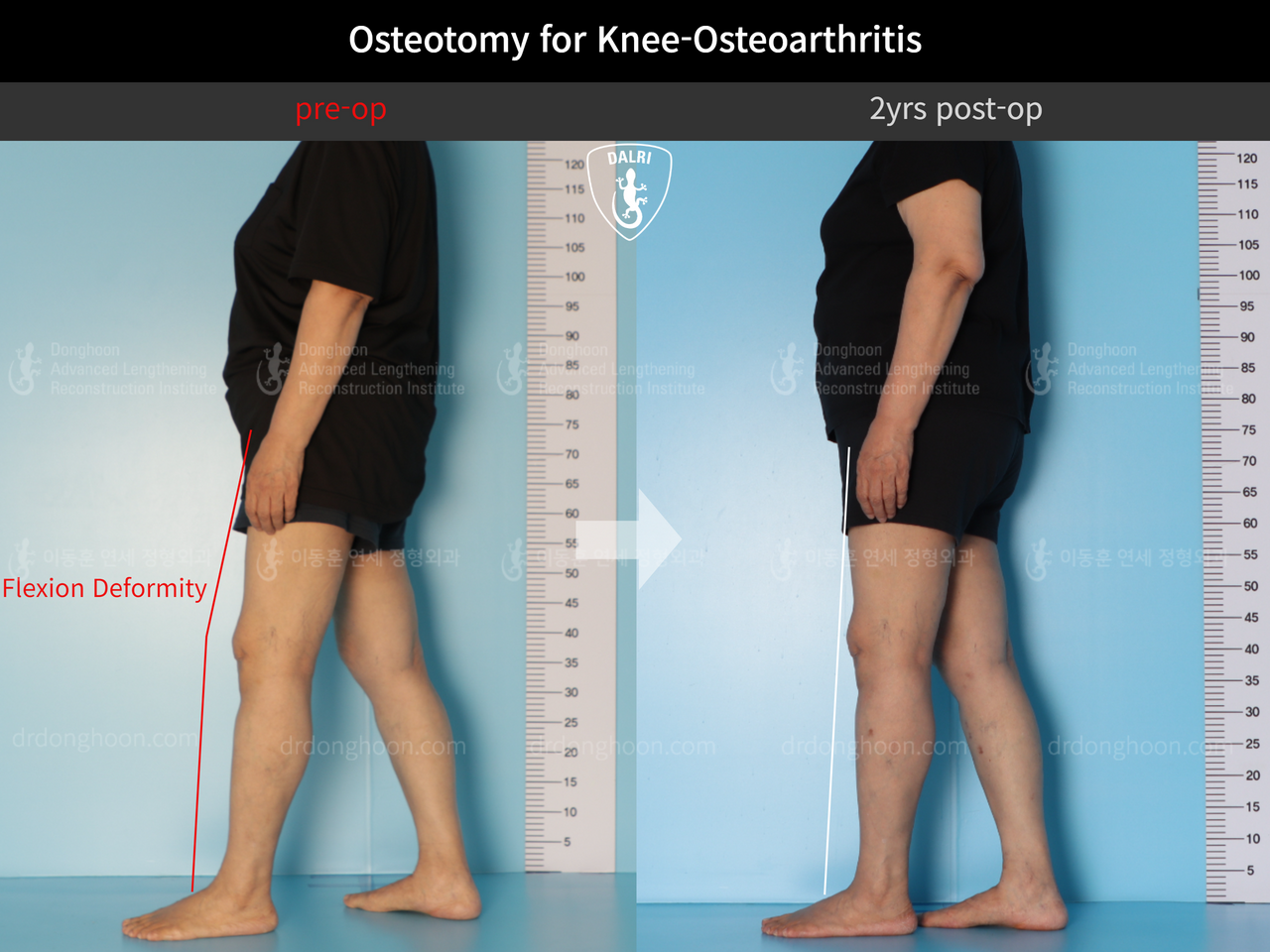 Before and after osteotomy for knee osteoarthritis, case 12844528, image 3, Dr. Donghoon institute (DALRI)