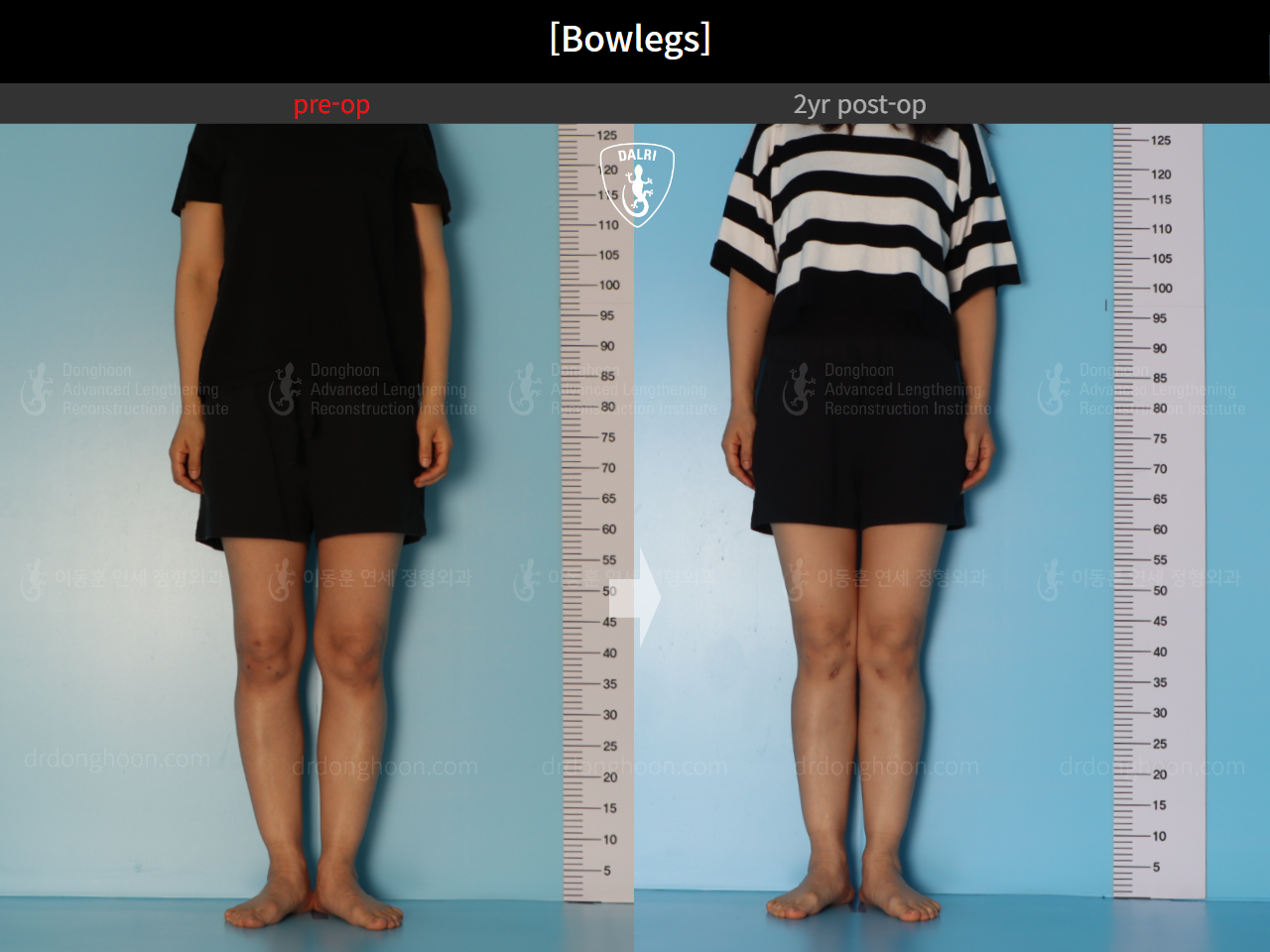 Before and after adult bowlegs, case 20942169, image 2, Dr. Donghoon institute (DALRI)