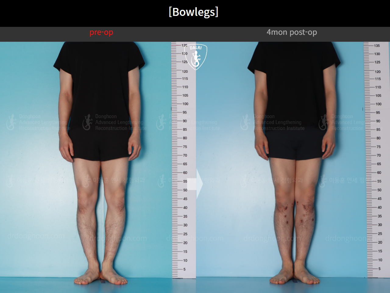 Before and after adult bowlegs, case 21098909, image 2, Dr. Donghoon institute (DALRI)