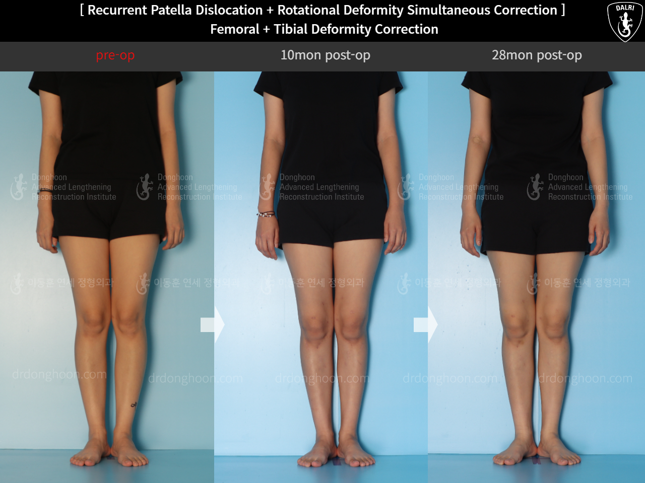 Before and after adult bowlegs, case 15131364, image 2, Dr. Donghoon institute (DALRI)