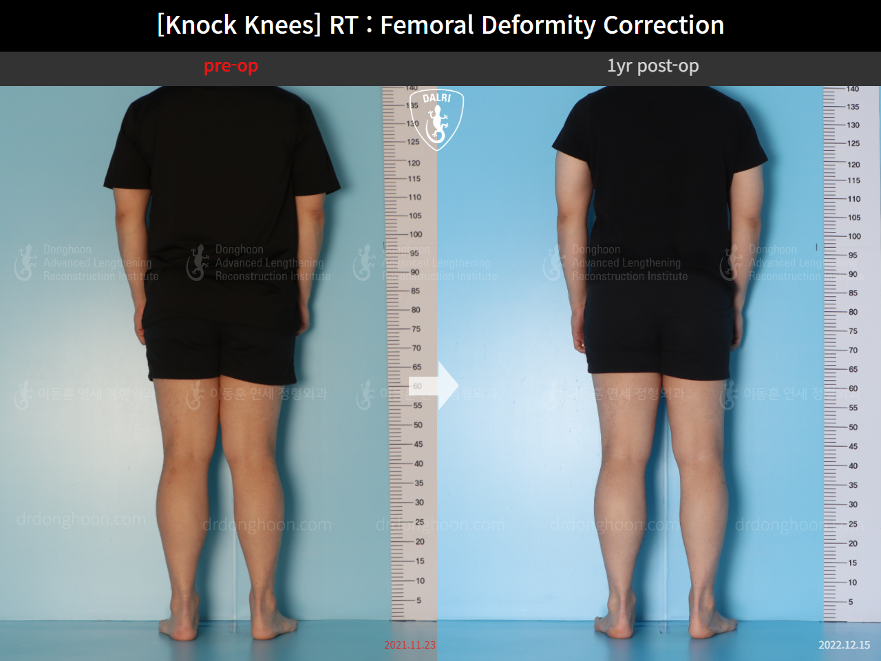 Before and after adult knock knees, case 15950751, image 6, Dr. Donghoon institute (DALRI)