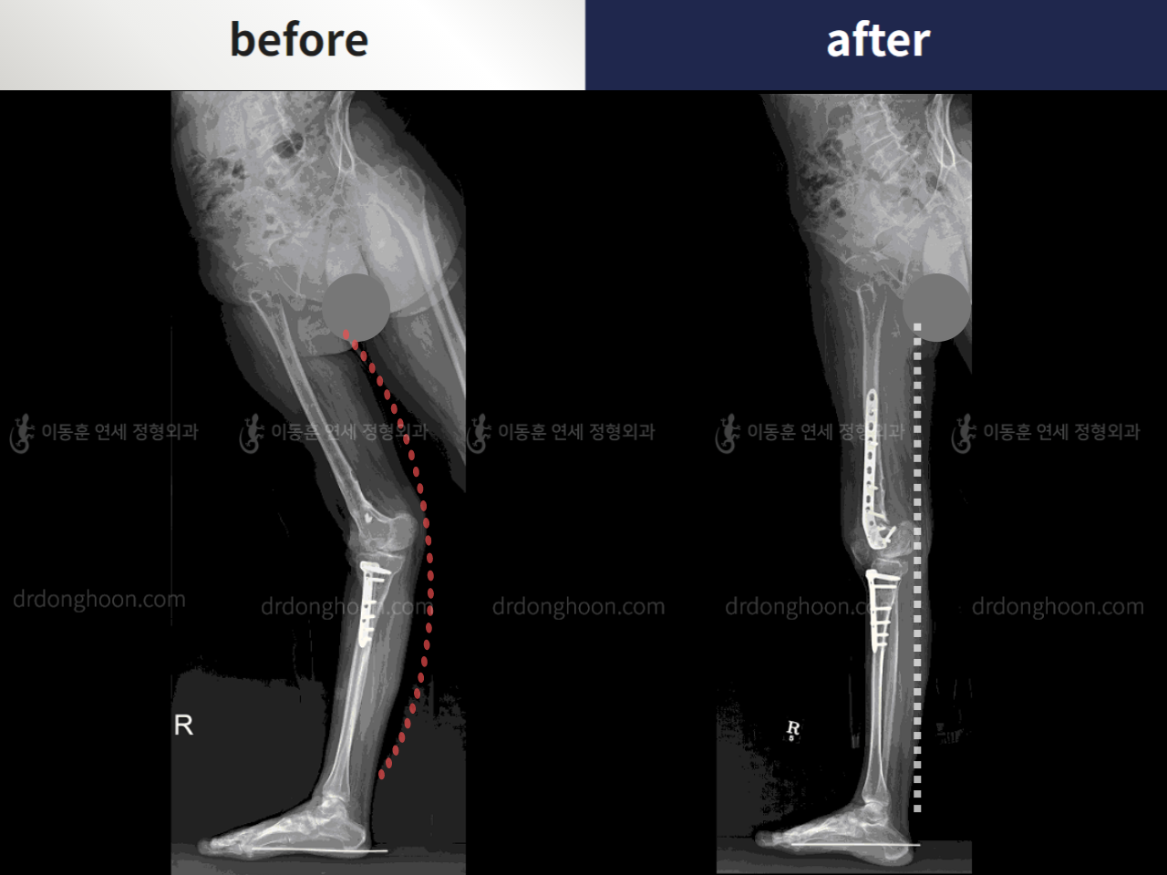 Before and after genu recurvatum, case 4250826, image 3, Dr. Donghoon institute (DALRI)