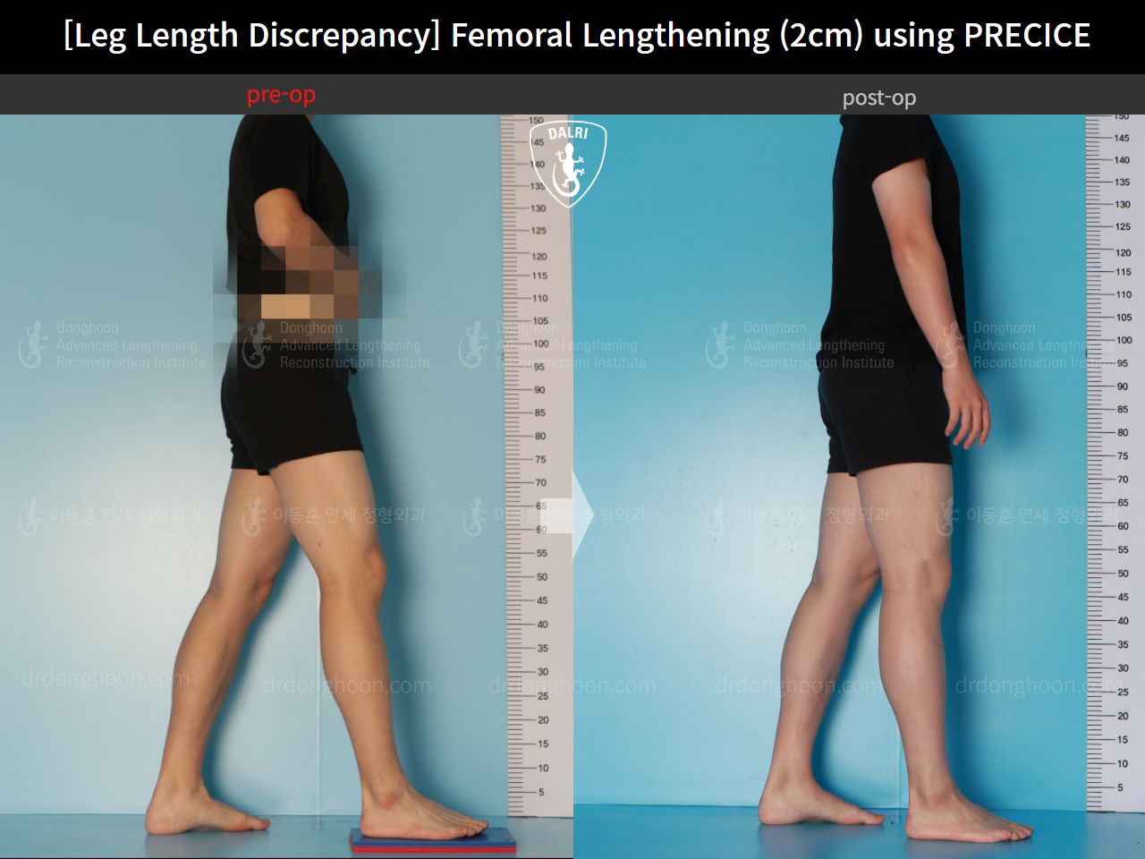 Before and after adult lld, case 16061128, image 3, Dr. Donghoon institute (DALRI)