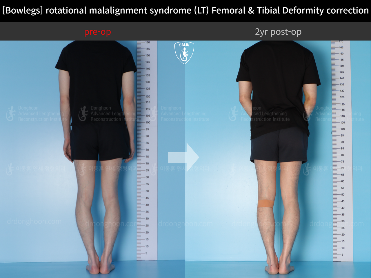 Before and after adult bowlegs, case 13266718, image 5, Dr. Donghoon institute (DALRI)
