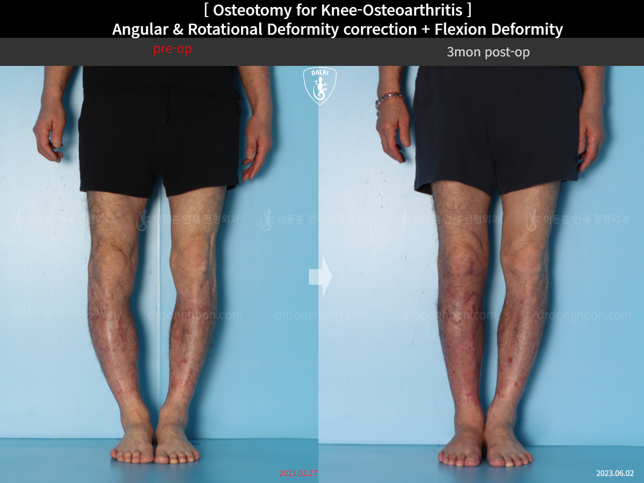 Before and after adult bowlegs, case 15362947, image 9, Dr. Donghoon institute (DALRI)