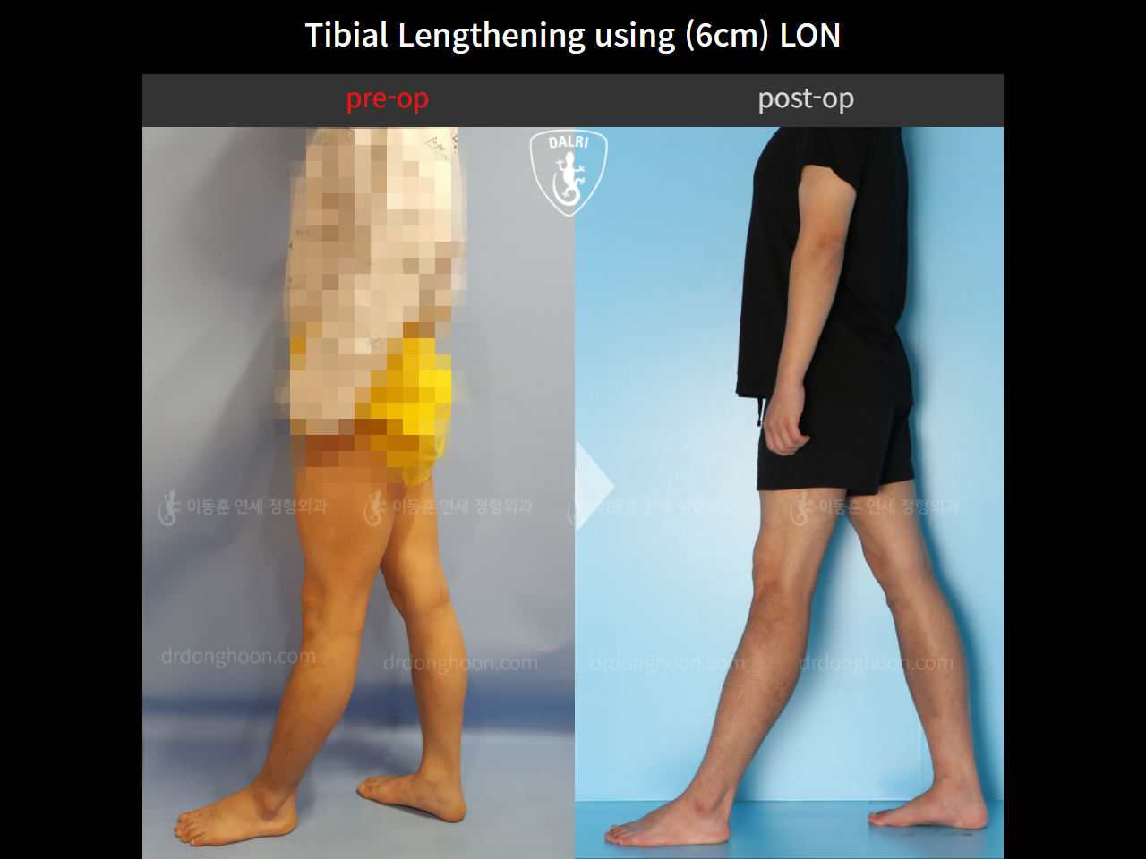 Before and after cll lon, case 11087271, image 4, Dr. Donghoon institute (DALRI)