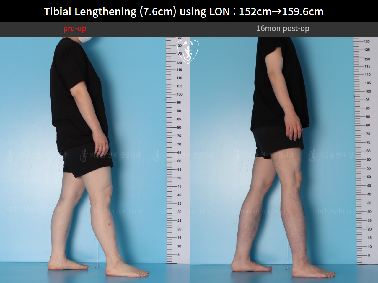Before and after cll lon, case 123804178, image 4, Dr. Donghoon institute (DALRI)