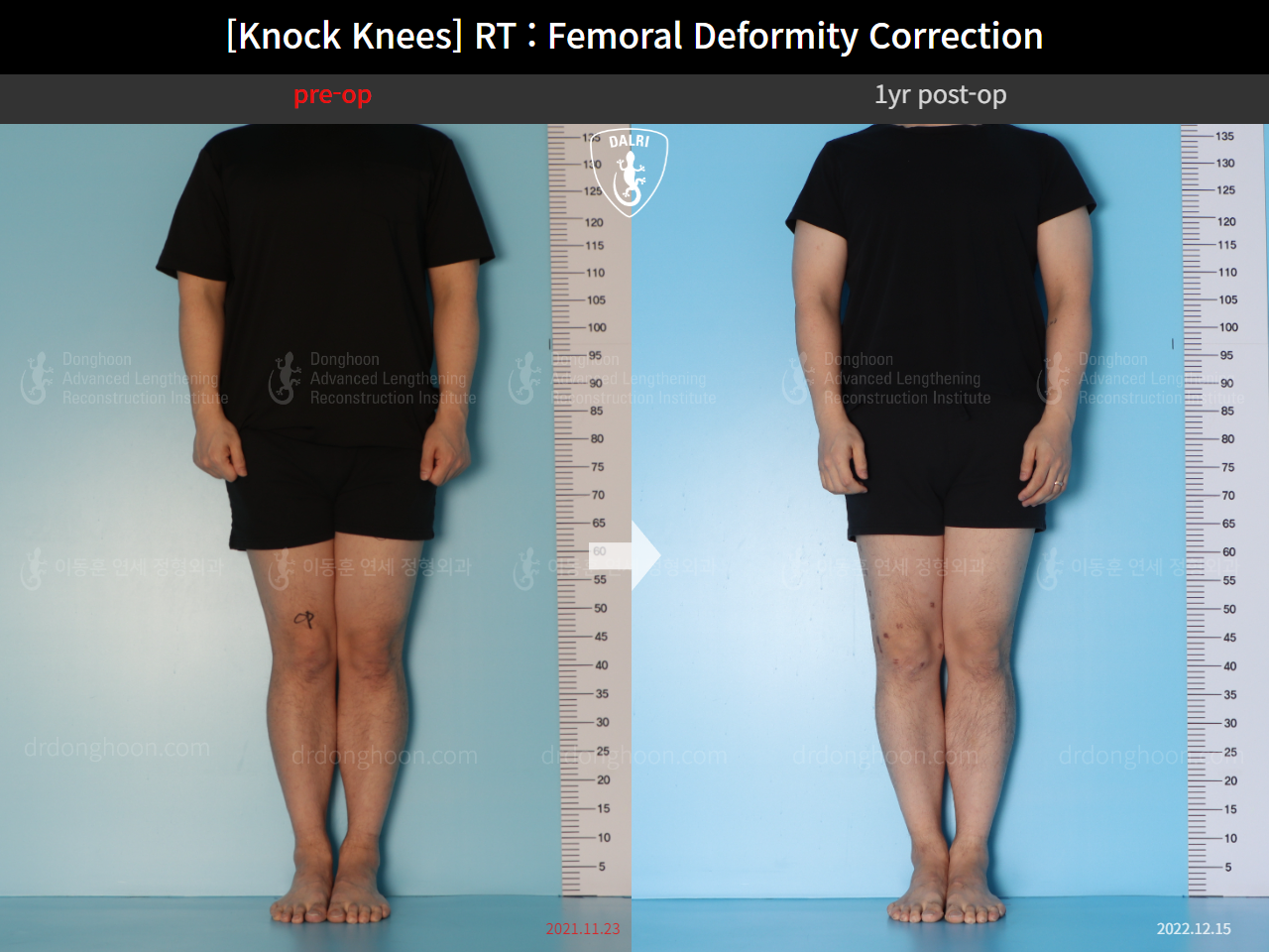 Before and after adult knock knees, case 15950751, image 2, Dr. Donghoon institute (DALRI)