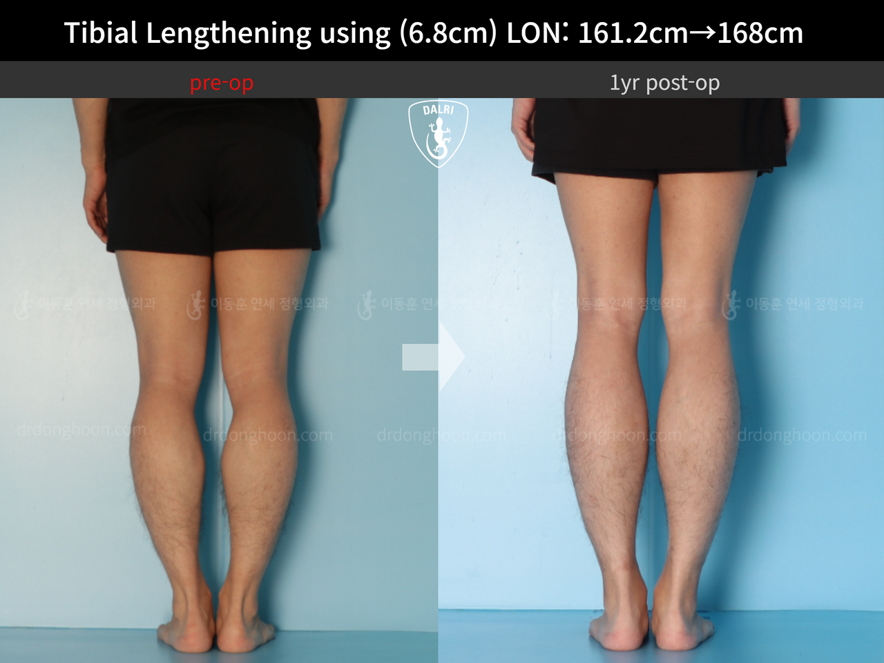Before and after cll lon, case 13633878, image 8, Dr. Donghoon institute (DALRI)