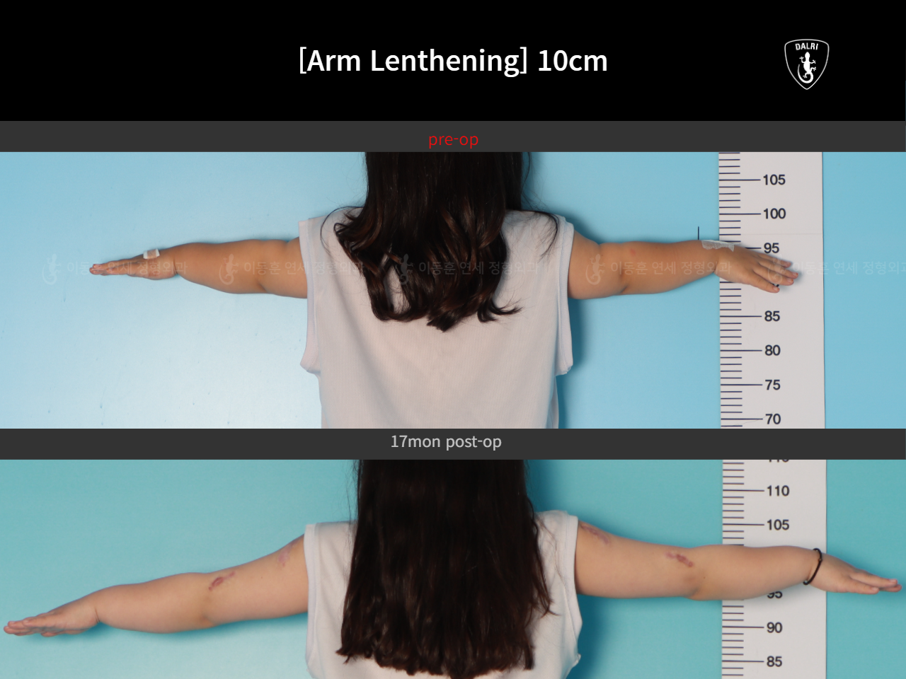 Before and after arm lengthening, case 17924395, image 6, Dr. Donghoon institute (DALRI)