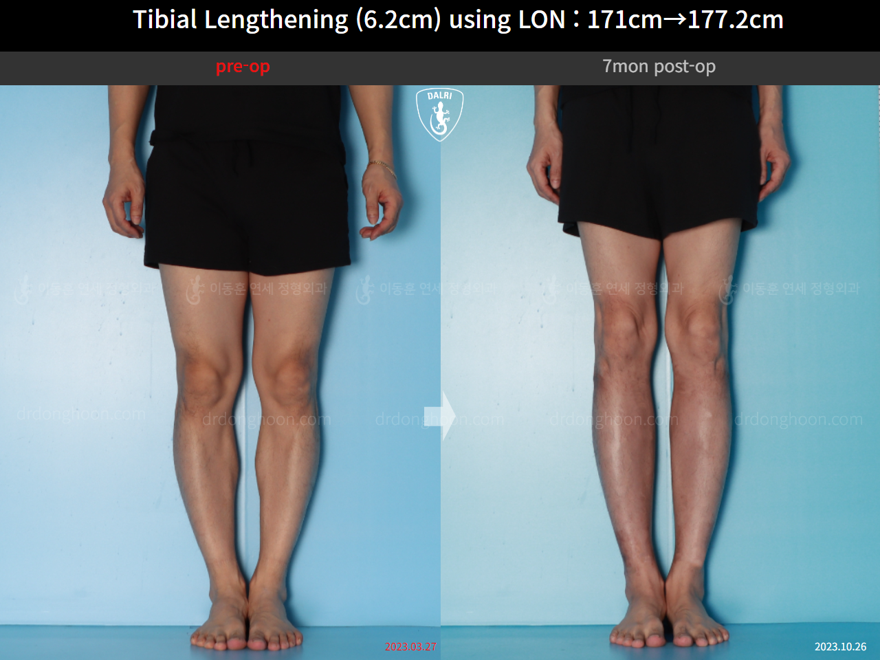 Before and after cll lon, case 16713373, image 8, Dr. Donghoon institute (DALRI)