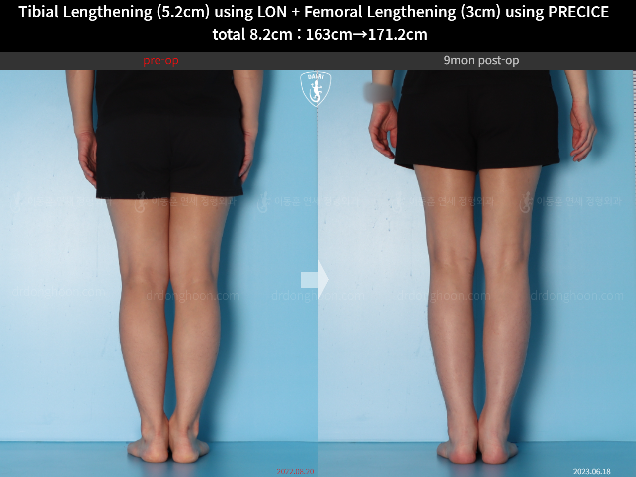 Before and after cll lon, case 15203339, image 11, Dr. Donghoon institute (DALRI)