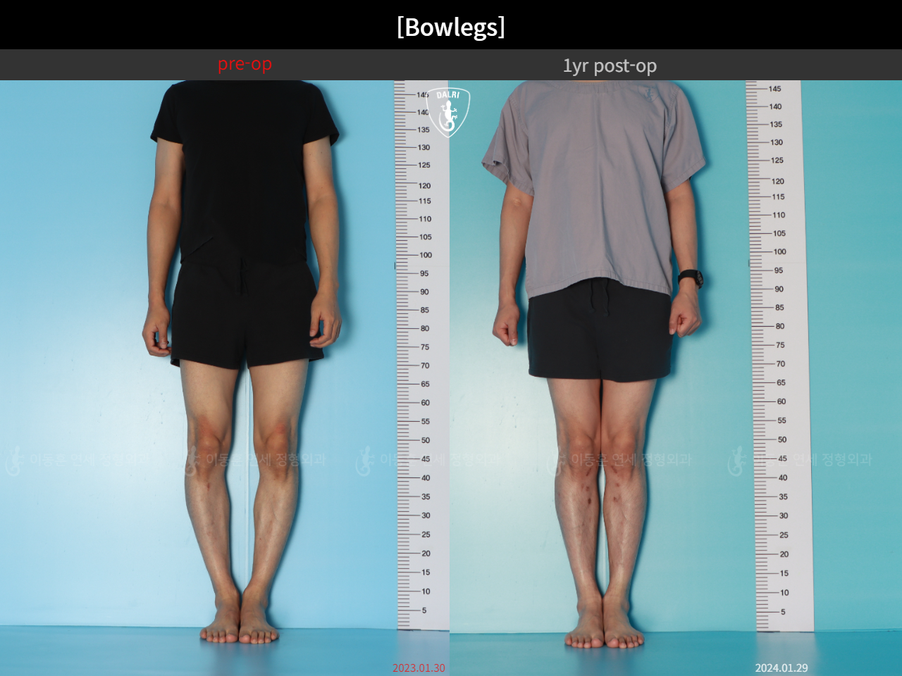 Before and after adult bowlegs, case 32564251, image 5, Dr. Donghoon institute (DALRI)