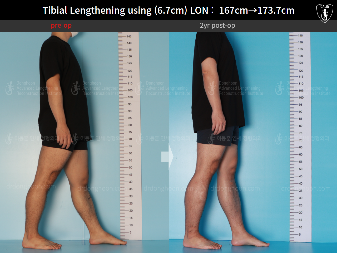 Before and after cll lon, case 16165376, image 6, Dr. Donghoon institute (DALRI)