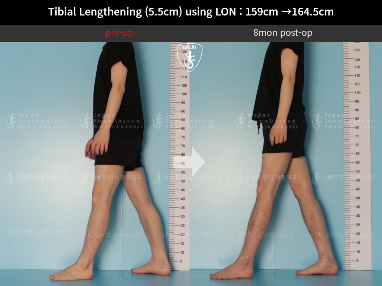 Before and after cll lon, case 10444923, image 3, Dr. Donghoon institute (DALRI)