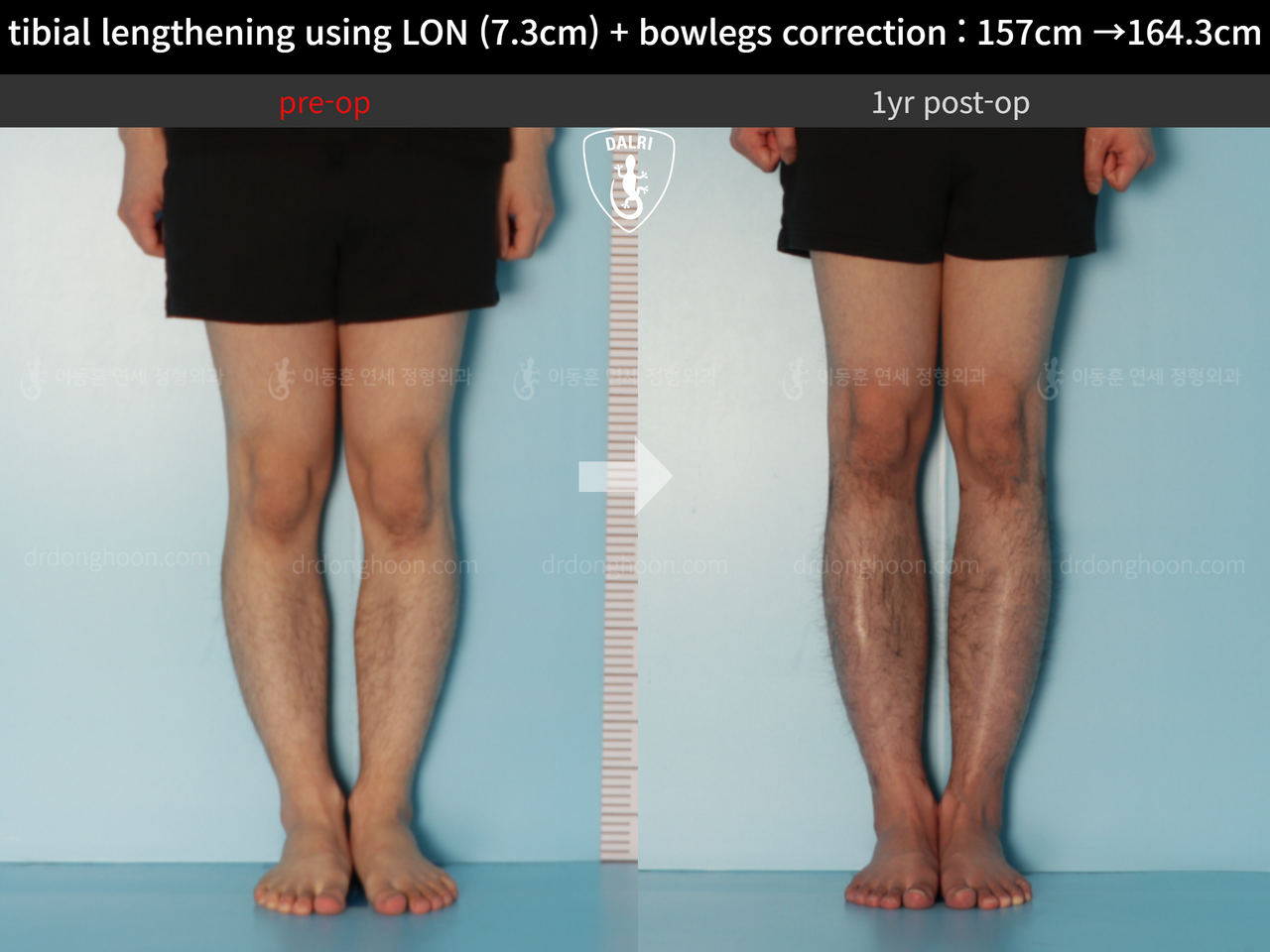 Before and after cll + deformity correction, case 13152543, image 5, Dr. Donghoon institute (DALRI)