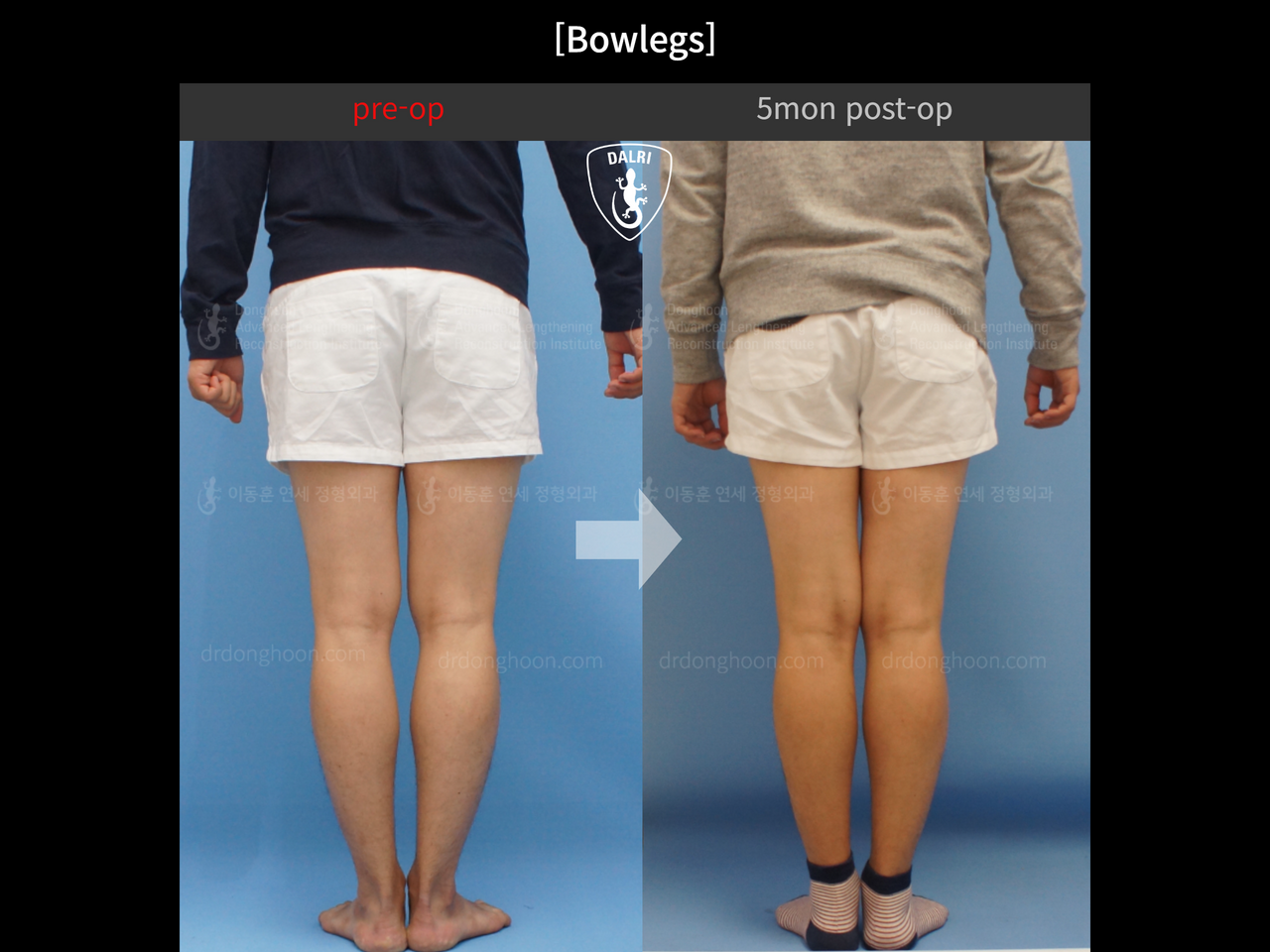 Before and after adult bowlegs, case 12818532, image 4, Dr. Donghoon institute (DALRI)