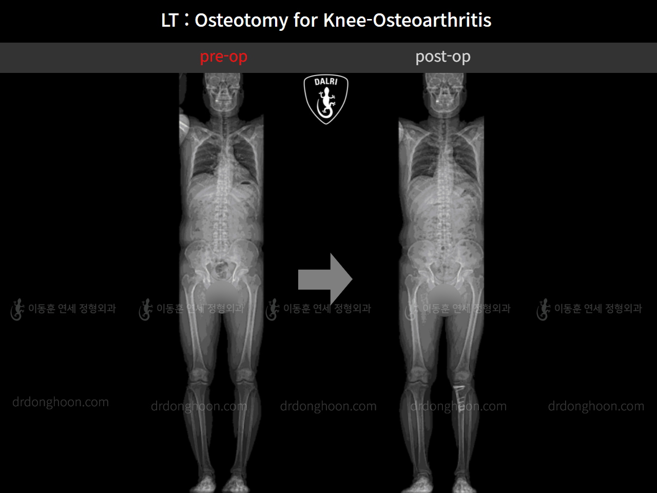Before and after osteotomy for knee osteoarthritis, case 11065448, image 5, Dr. Donghoon institute (DALRI)