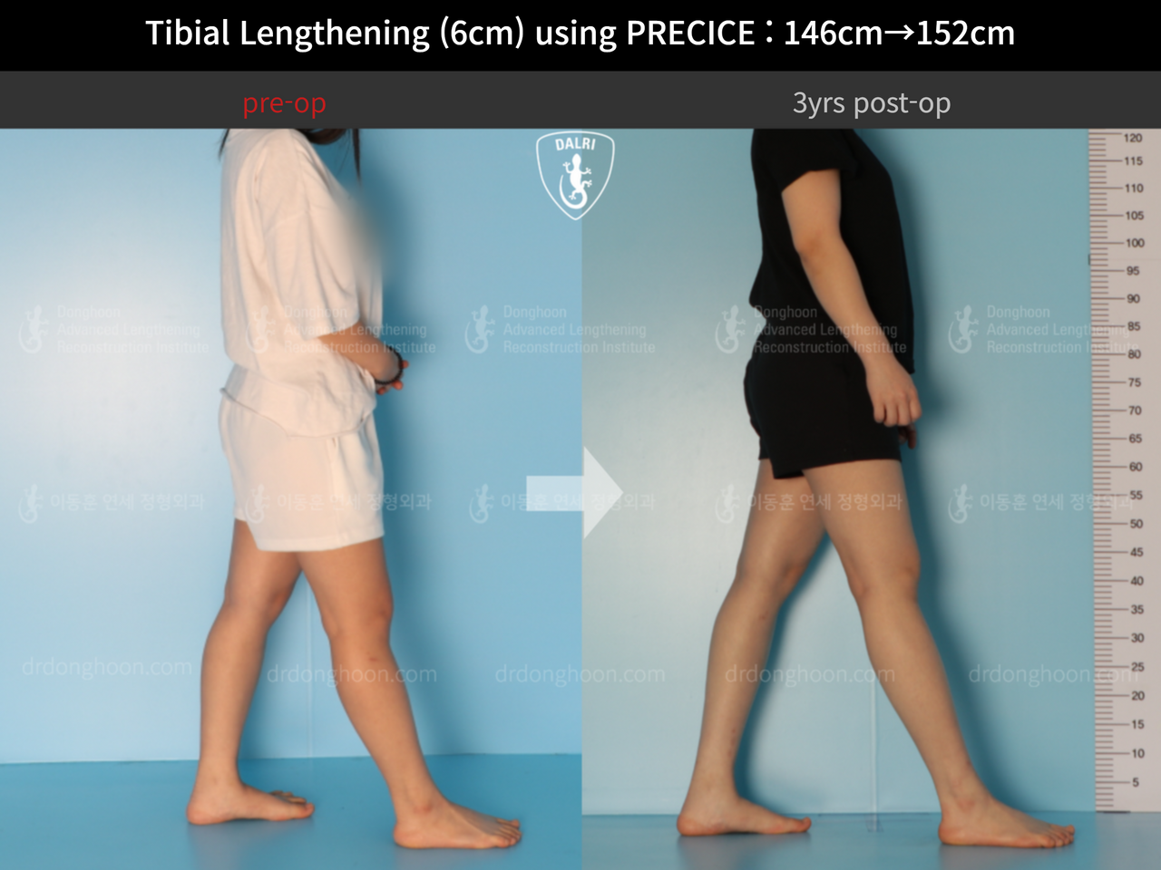 Before and after cll precice, case 4573599, image 4, Dr. Donghoon institute (DALRI)
