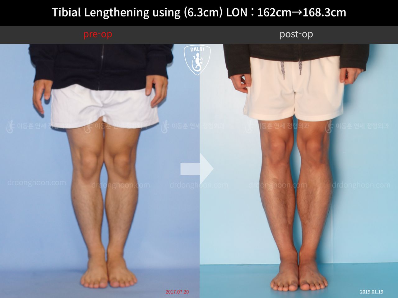 Before and after cll lon, case 12817675, image 4, Dr. Donghoon institute (DALRI)