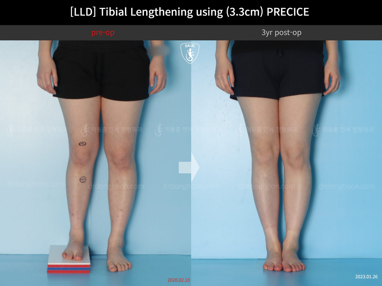 Before and after adult lld, case 14064905, image 7, Dr. Donghoon institute (DALRI)