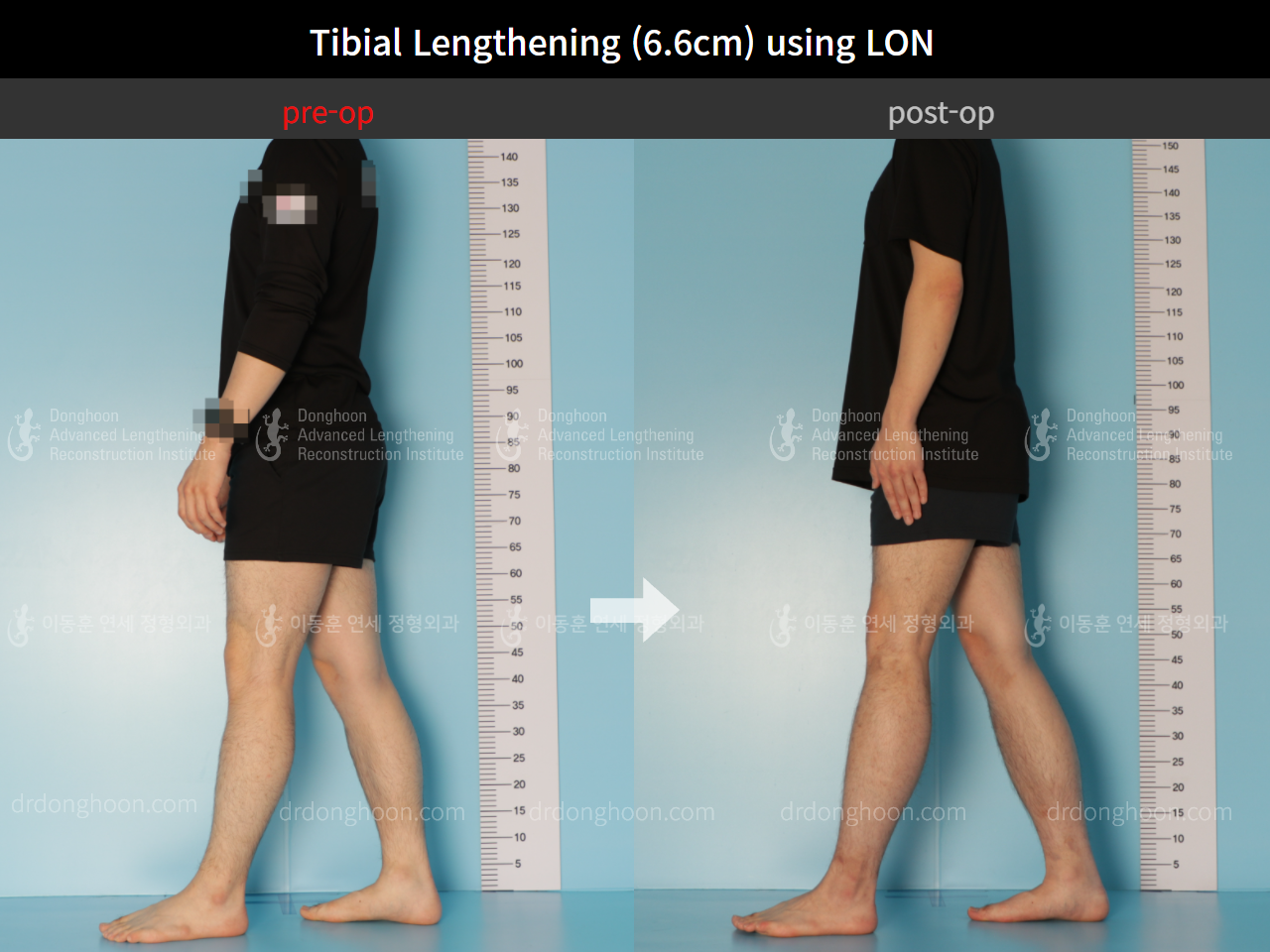 Before and after cll lon, case 8764128, image 4, Dr. Donghoon institute (DALRI)
