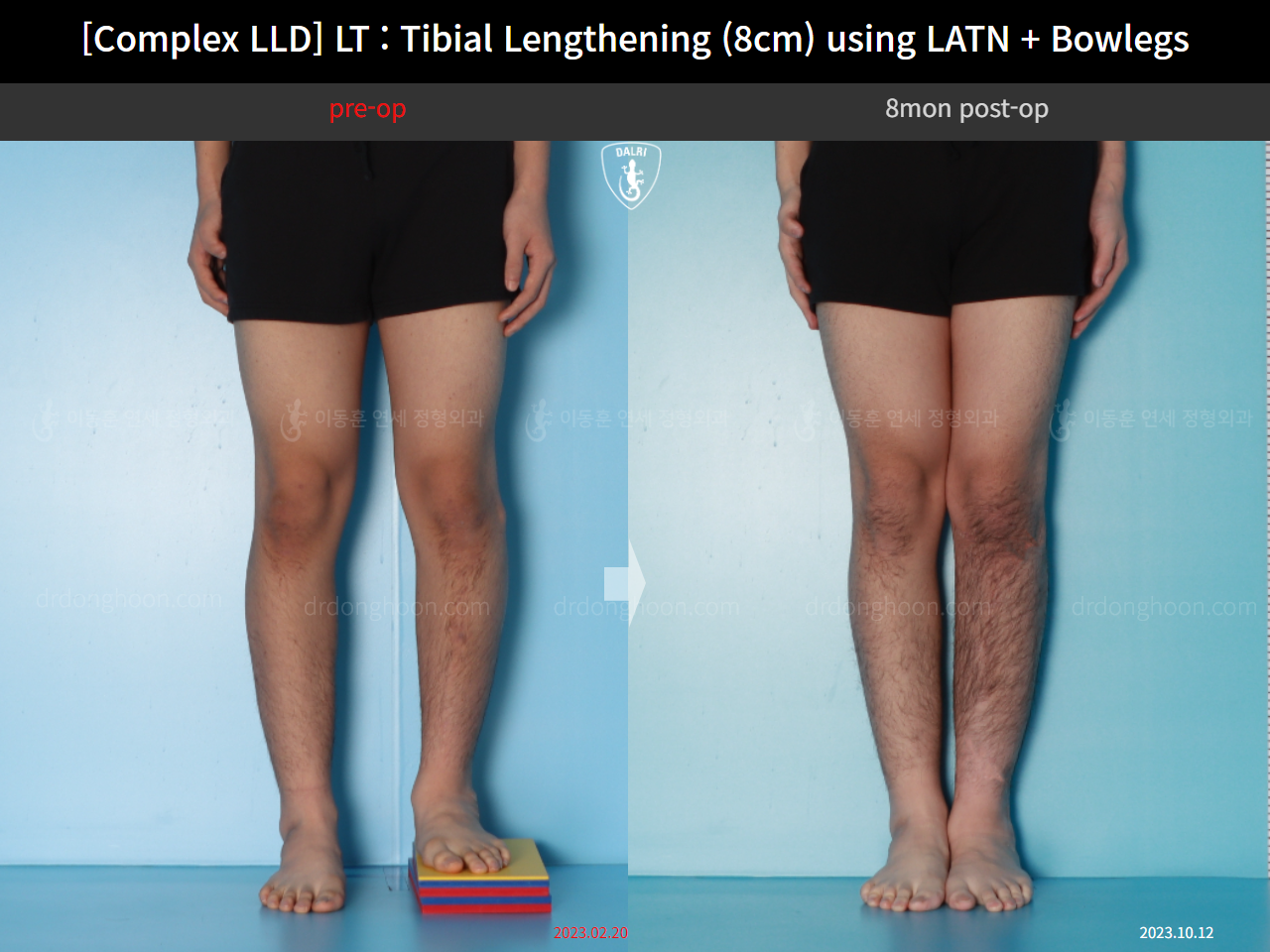 Before and after adult lld, case 16724300, image 5, Dr. Donghoon institute (DALRI)