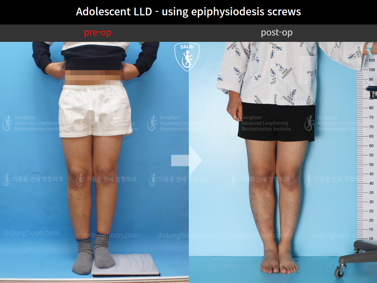 Before and after paediatric & adolescent lld, case 10452092, image 1, Dr. Donghoon institute (DALRI)