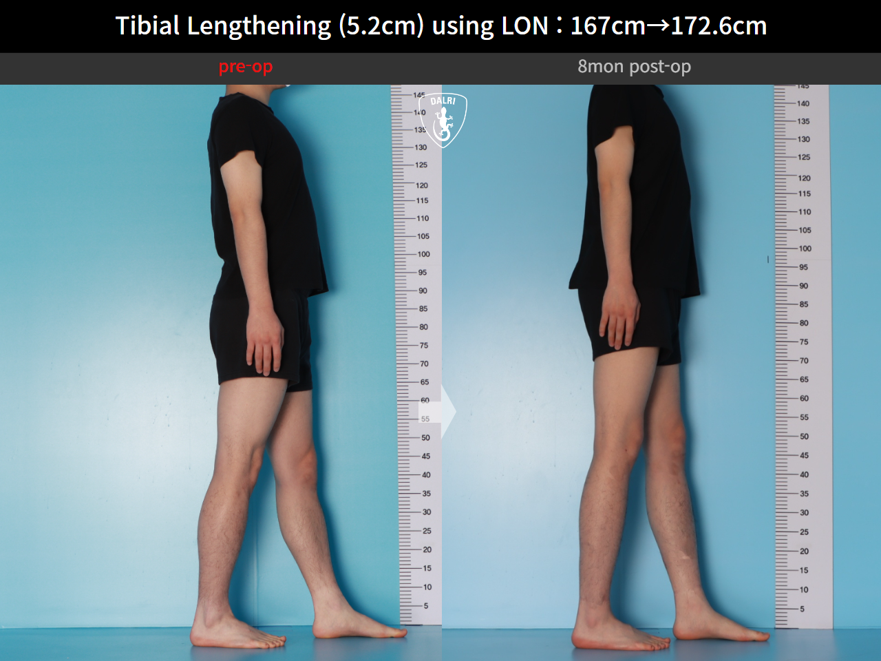 Before and after cll lon, case 29672720, image 6, Dr. Donghoon institute (DALRI)