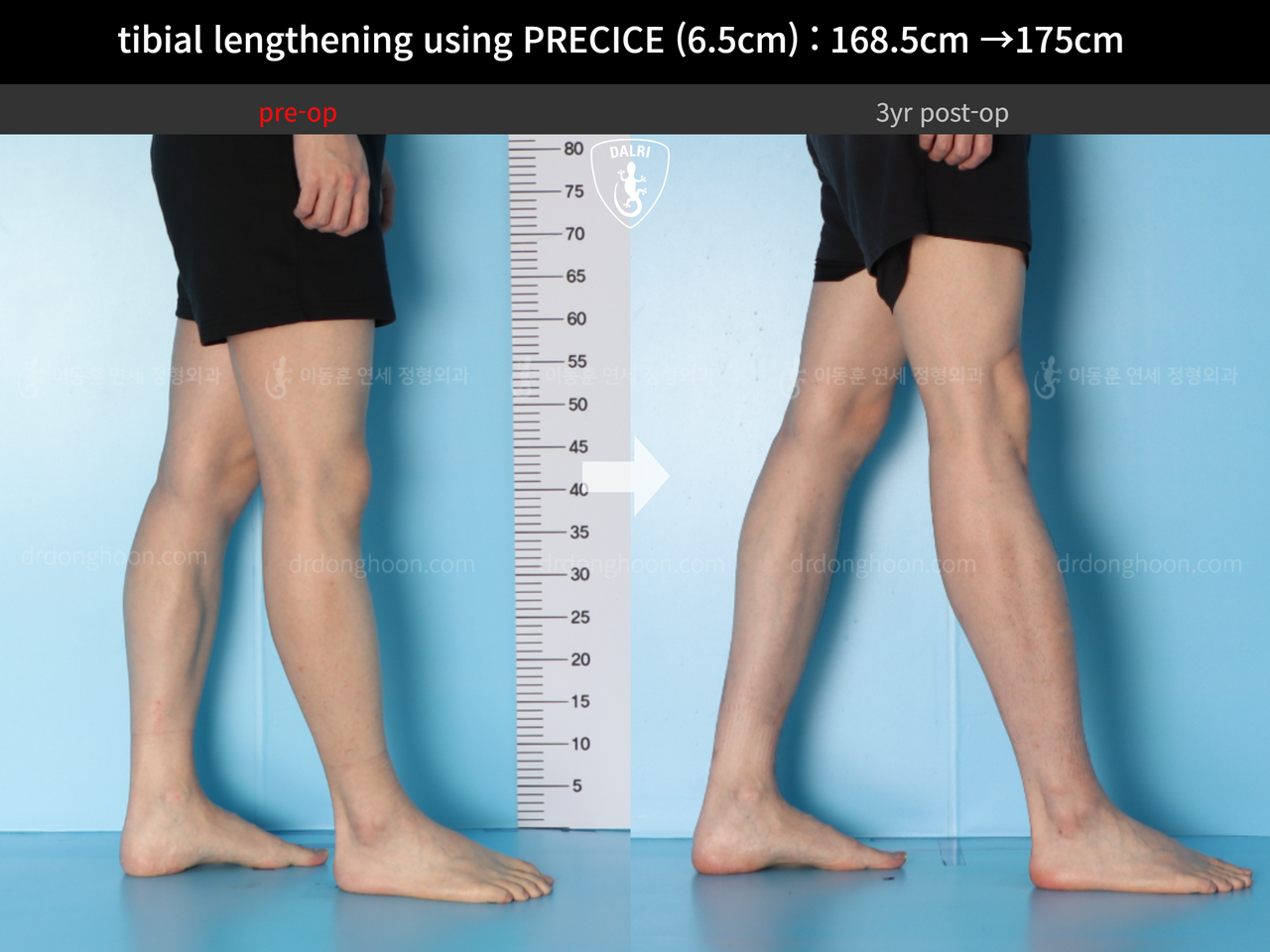 Before and after cll precice, case 13661572, image 9, Dr. Donghoon institute (DALRI)