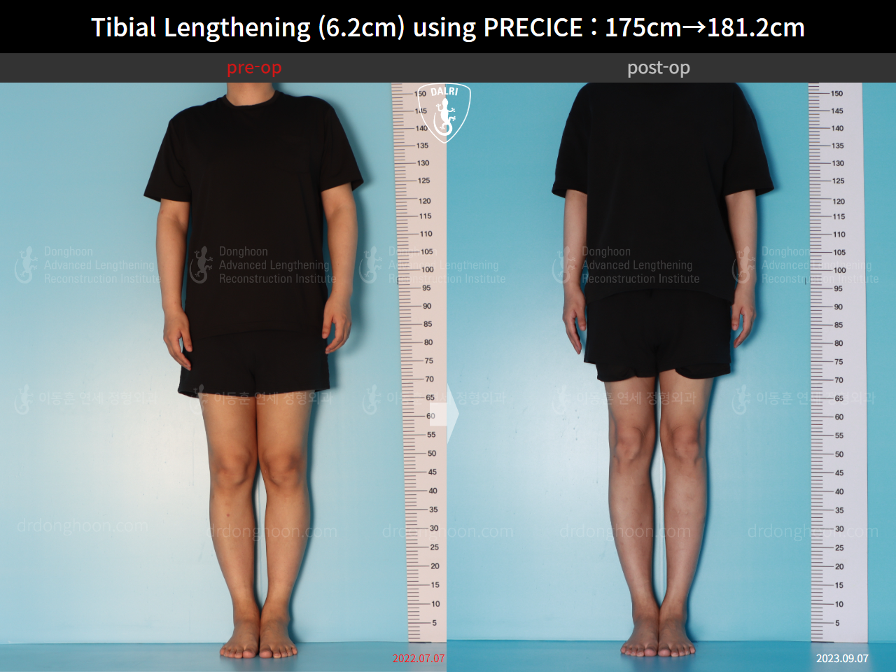 Before and after cll precice, case 16277428, image 1, Dr. Donghoon institute (DALRI)