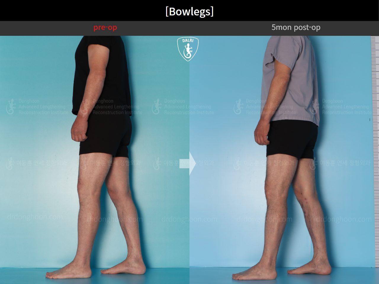 Before and after adult bowlegs, case 24988060, image 5, Dr. Donghoon institute (DALRI)