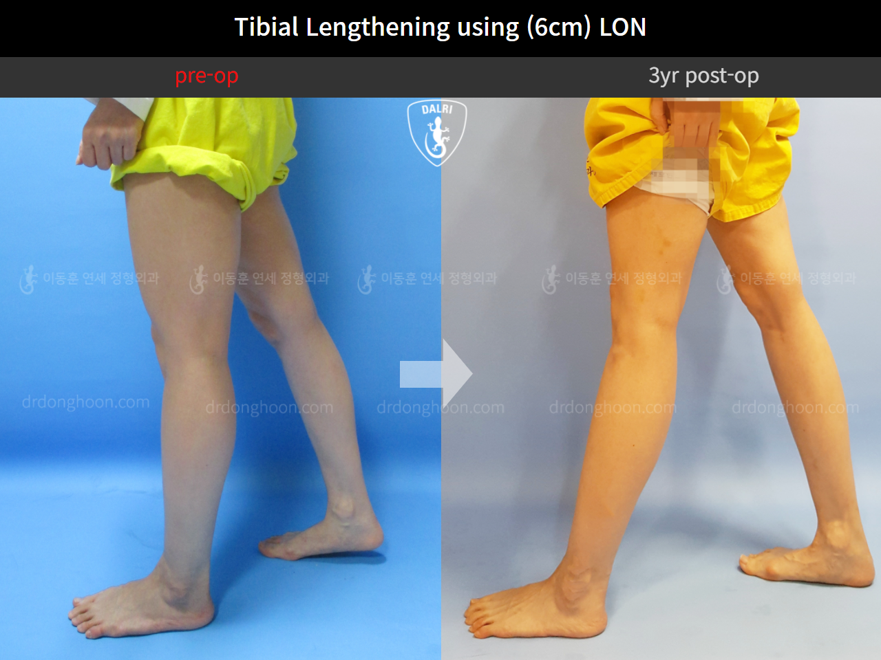 Before and after cll lon, case 4323981, image 8, Dr. Donghoon institute (DALRI)
