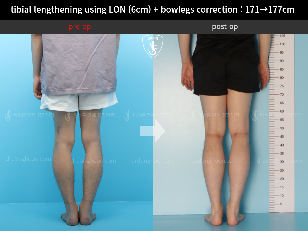 Before and after cll + deformity correction, case 11798378, image 3, Dr. Donghoon institute (DALRI)