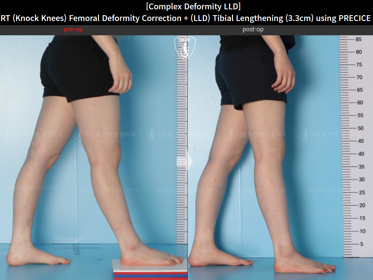 Before and after adult lld, case 15584036, image 8, Dr. Donghoon institute (DALRI)