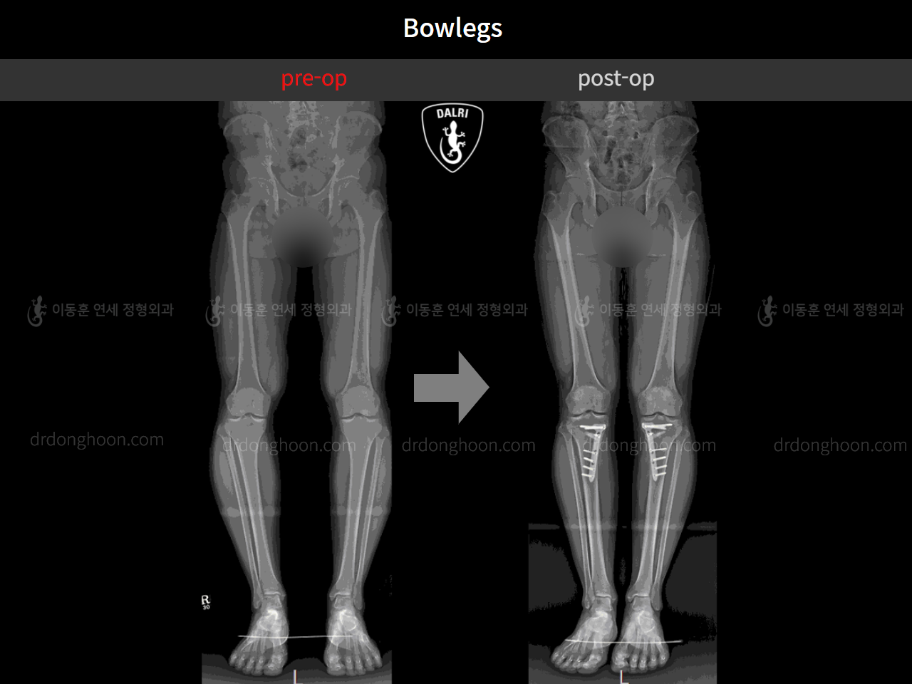 Before and after adult bowlegs, case 4311035, image 5, Dr. Donghoon institute (DALRI)