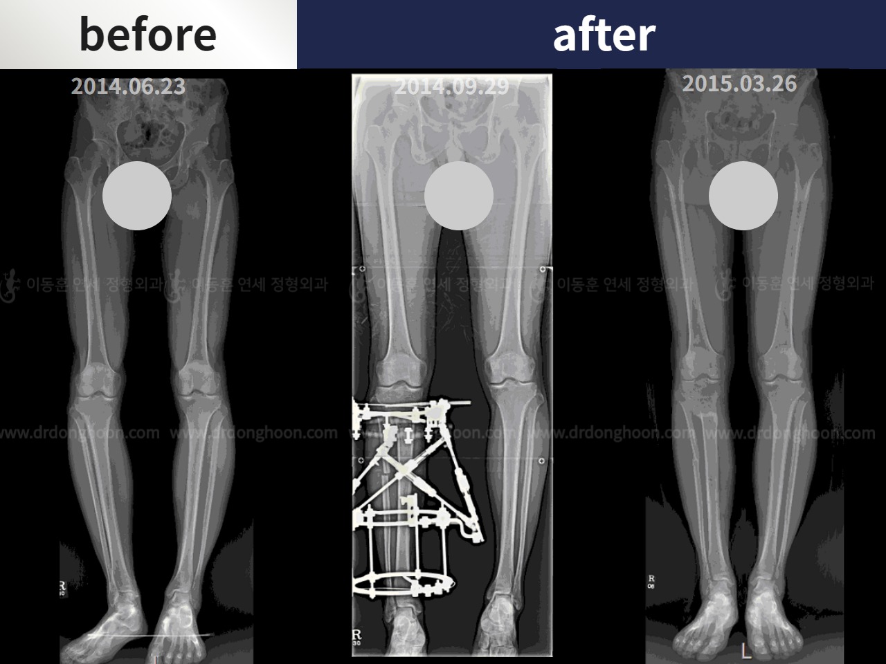 Before and after adult bowlegs, case 4311368, image 3, Dr. Donghoon institute (DALRI)