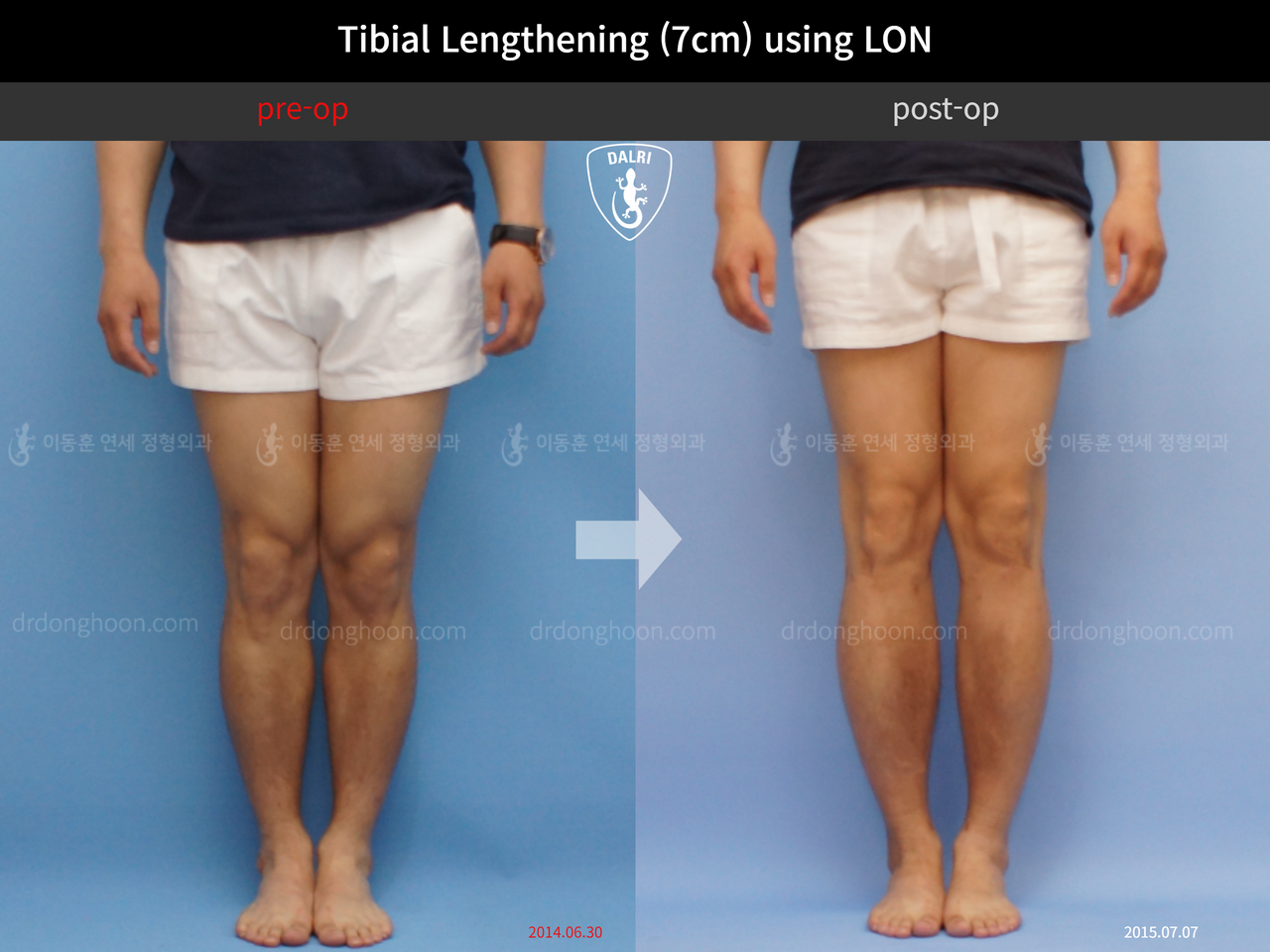 Before and after cll lon, case 11990480, image 3, Dr. Donghoon institute (DALRI)