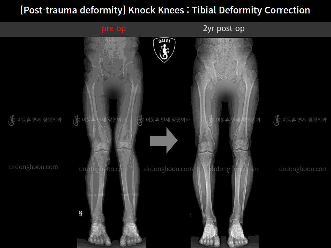 Before and after adult knock knees, case 4310821, image 6, Dr. Donghoon institute (DALRI)