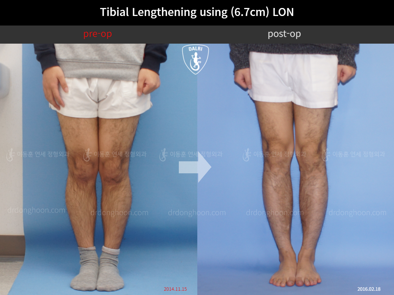 Before and after cll lon, case 10803349, image 3, Dr. Donghoon institute (DALRI)