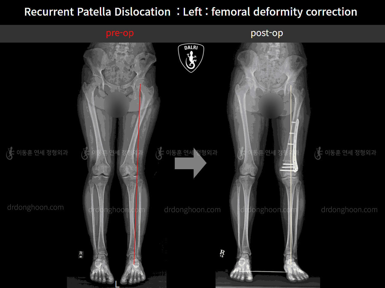 Before and after recurrent patella dislocation, case 10546870, image 5, Dr. Donghoon institute (DALRI)