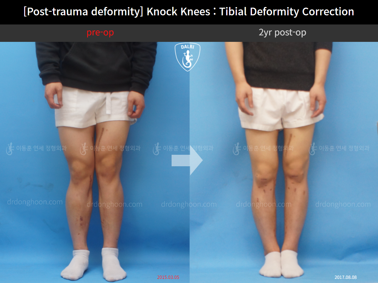 Before and after post-trauma deformity, case 9758216, image 1, Dr. Donghoon institute (DALRI)
