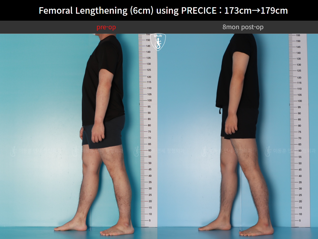 Before and after cll precice, case 89066969, image 6, Dr. Donghoon institute (DALRI)