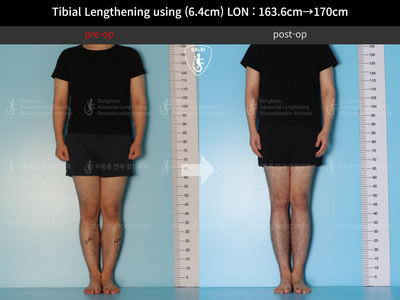 Before and after cll lon, case 12779092, image 1, Dr. Donghoon institute (DALRI)