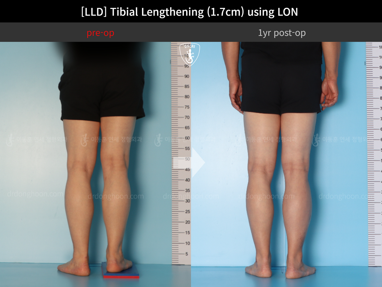 Before and after adult lld, case 13261805, image 5, Dr. Donghoon institute (DALRI)