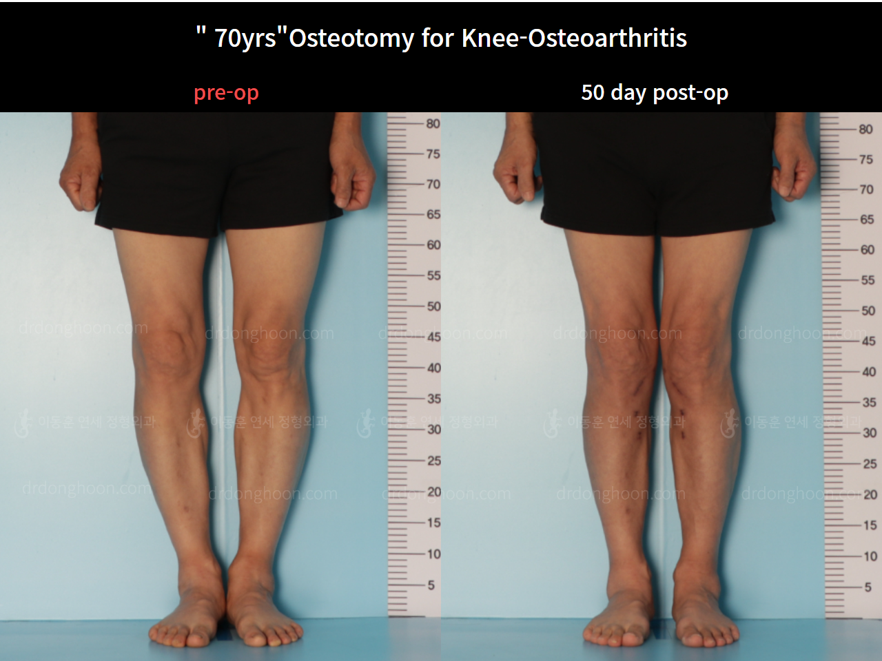 Before and after osteotomy for knee osteoarthritis, case 7753851, image 1, Dr. Donghoon institute (DALRI)