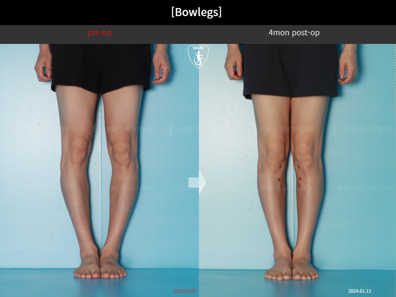Before and after adult bowlegs, case 17962599, image 8, Dr. Donghoon institute (DALRI)