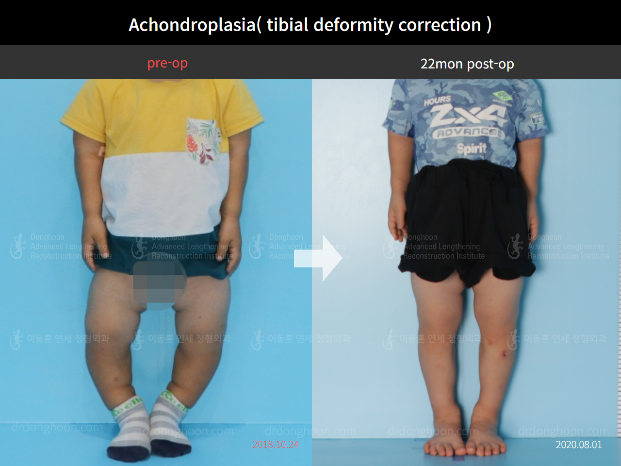 Before and after paediatric congenital condition, case 4304782, image 1, Dr. Donghoon institute (DALRI)