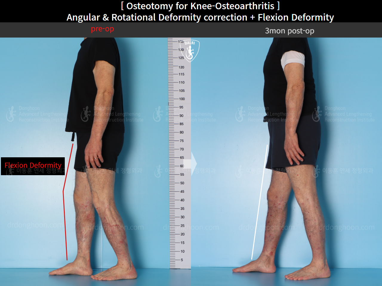 Before and after adult bowlegs, case 15362947, image 8, Dr. Donghoon institute (DALRI)