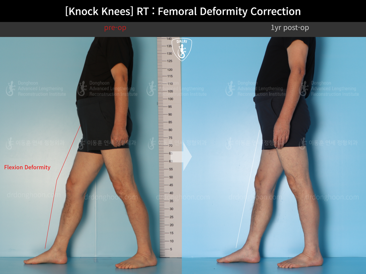 Before and after adult knock knees, case 14236357, image 4, Dr. Donghoon institute (DALRI)